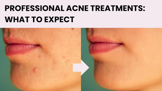 Professional Acne Treatments: What to Expect