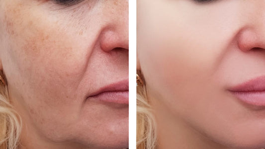 How to Remove Pigmentation from the Face Permanently?